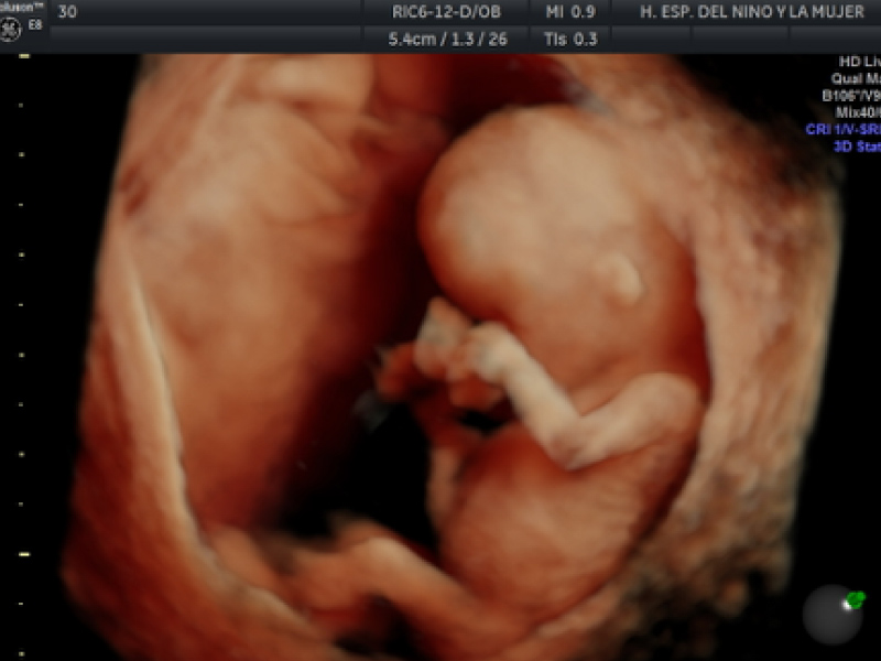 Banner uno Diagnóstico Prenatal en Primer Trimestre